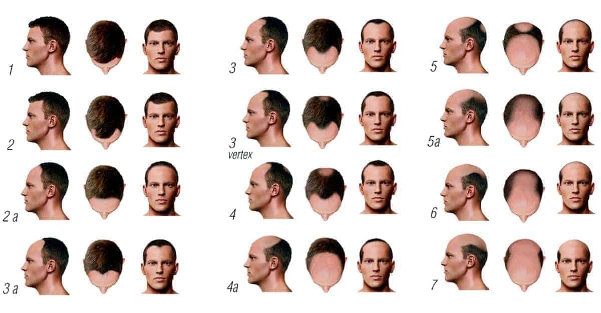 Norwood Scale for measuring male baldness